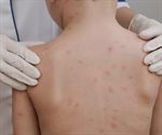 Avances en la vacunación contra el sarampión en Chihuahua