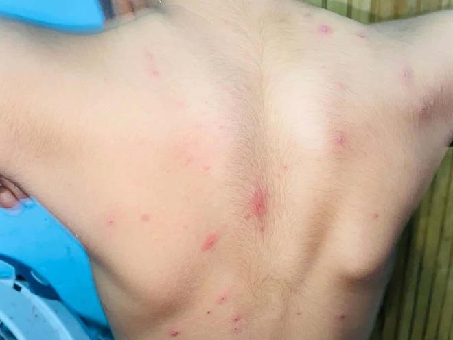 Suman 866 casos de virus manos-pie-boca en Tamaulipas