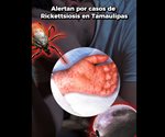 Detectan casos probables de Rickettsiosis en personas de Reynosa y Nuevo Laredo