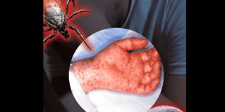 Detectan casos probables de Rickettsiosis en personas de Reynosa y Nuevo Laredo