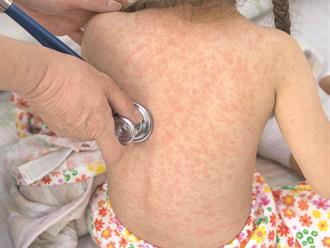 Exhortan a vacunarse contra el sarampión