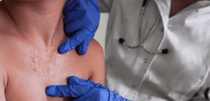 Sarampión en México: cuáles son los síntomas y cómo prevenir contagio