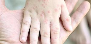 Niegan crisis de sarampión