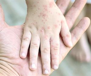 Niegan crisis de sarampión