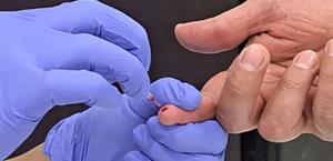 Detectan 5 nuevos casos sospechosos de VIH/SIDA