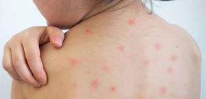 Suma Tamaulipas 12 casos de Sarampión