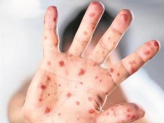 Declaran alerta por brote de sarampión en estado de Jalisco, una de las sedes mexicanas del Mundial