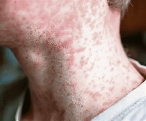 CDMX reporta primer deceso por sarampión; suman 28 en el país