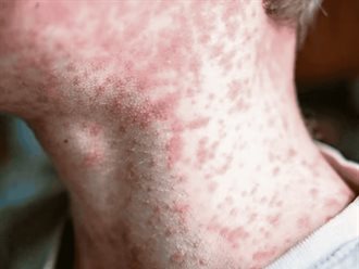 CDMX reporta primer deceso por sarampión; suman 28 en el país