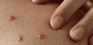 ¿Crees que en México se tenga control en los contagios de Sarampión?