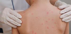 Alertan sobre síntomas y riesgos del sarampión