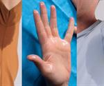 “Cuando sudar deja de ser normal: hiperhidrosis en tiempos de calor”