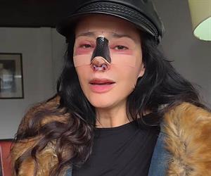 Reaparece tras  reconstrucción nasal