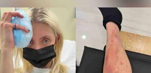 Hospitalizada en CDMX por piquete de araña