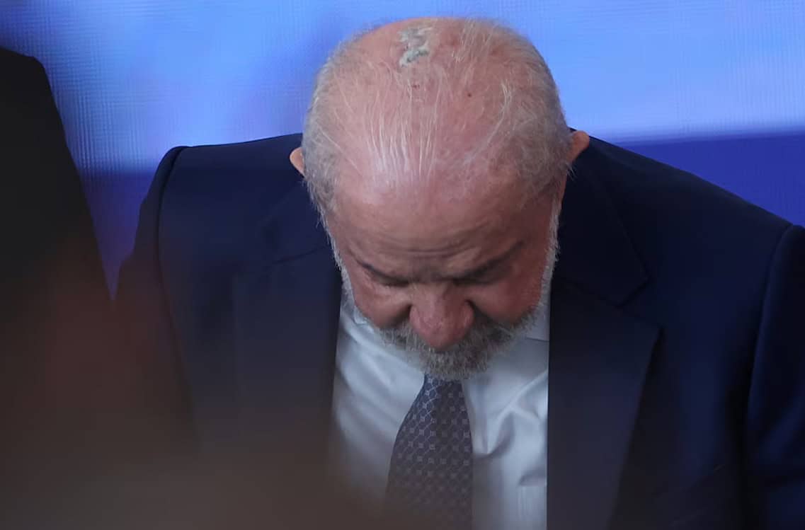 Lula inicia radioterapia por cáncer de piel