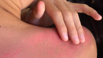Exhortan a cuidar la piel por intenso calor